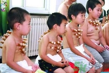 小孩可以拔罐嗎？寶寶能拔火罐嗎？