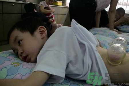 小孩可以拔罐嗎？寶寶能拔火罐嗎？