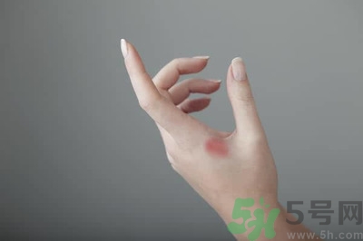 手被燙紅了怎么辦？手被燙了怎么止痛？