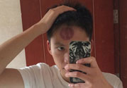 頭痛可以在額頭上拔火罐嗎？額頭上拔火罐有什么好處？