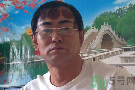 頭痛可以在額頭上拔火罐嗎？額頭上拔火罐有什么好處？