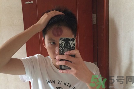 頭痛可以在額頭上拔火罐嗎？額頭上拔火罐有什么好處？