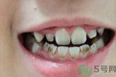 小孩牙齒發(fā)黑怎么回事？小孩牙齒發(fā)黑怎么辦？