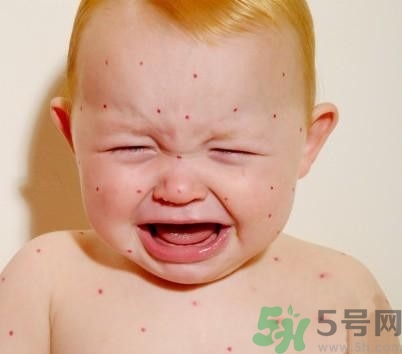 新生兒濕疹怎么引起的？新生兒濕疹如何處理？