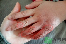 生凍瘡癢怎么辦？生凍瘡很癢的時候怎么辦？