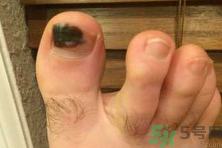 腳趾甲變黑是什么原因？腳趾甲變黑是怎么回事？