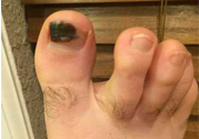 腳趾甲變黑是什么原因？腳趾甲變黑是怎么回事？