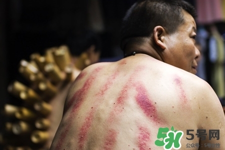 背部刮痧后能拔火罐嗎？背部刮痧后拔火罐有什么好處？