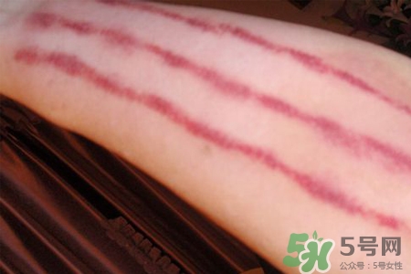 揪痧和刮痧哪個效果比較好？揪痧和刮痧的區(qū)別？