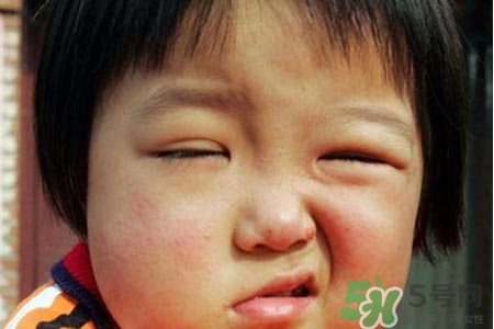 面癱能針灸嗎？針灸能治療面癱嗎？