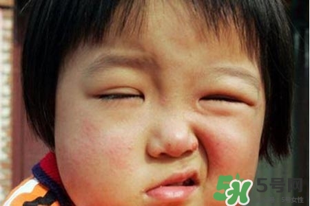 拔牙會導(dǎo)致面癱嗎?？拔牙為什么會導(dǎo)致面癱？