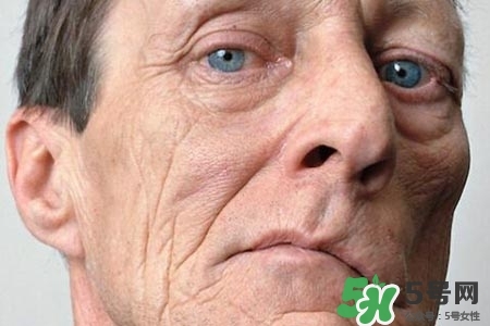 老年人為什么容易得面癱？老年人面癱原因有哪些？