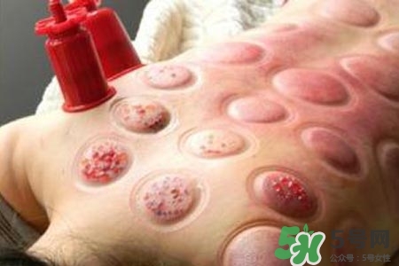 拔罐放血對身體好嗎？拔罐放血有什么好處？