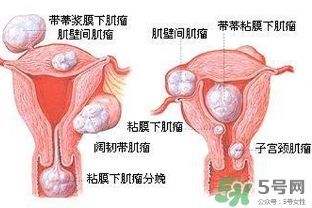 子宮小會影響生育嗎？子宮小會導(dǎo)致不孕嗎？