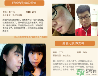芷軒堂祛痘有效果嗎？芷軒堂祛痘印效果怎么樣？