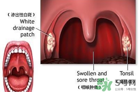 口含大蒜能治療咽炎嗎？巧用大蒜治療咽炎咳嗽