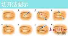 定點雙眼皮怎么做？定點雙眼皮需要拆線嗎？
