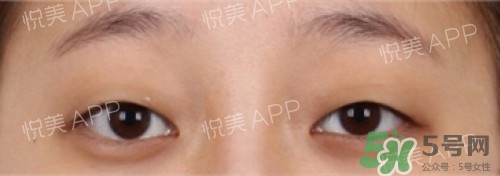 埋線雙眼皮多久恢復(fù)自然？埋線雙眼皮多久能恢復(fù)