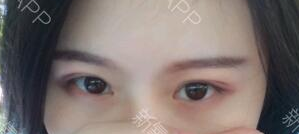 定點(diǎn)雙眼皮能保持多久？定點(diǎn)雙眼皮是永久的嗎？