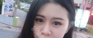 定點(diǎn)雙眼皮能保持多久？定點(diǎn)雙眼皮是永久的嗎？