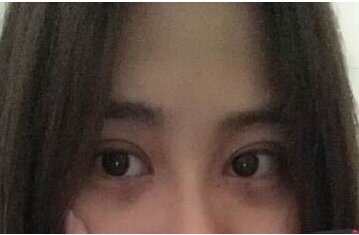 定點雙眼皮怎么做？定點雙眼皮需要拆線嗎？
