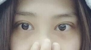 定點雙眼皮怎么做？定點雙眼皮需要拆線嗎？