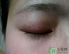 埋線雙眼皮需要拆線嗎？埋線雙眼皮怎么拆線