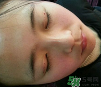 埋線雙眼皮需要拆線嗎？埋線雙眼皮怎么拆線