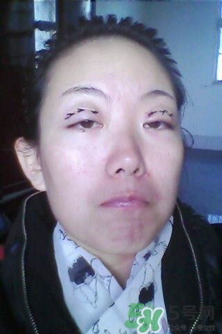 什么是定點雙眼皮？定點雙眼皮多少錢？