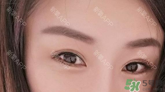 埋線雙眼皮能保持多久？埋線雙眼皮是永久嗎