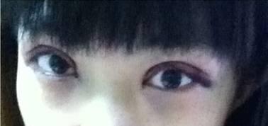 韓式三點(diǎn)雙眼皮是永久嗎？三點(diǎn)雙眼皮能保持多久？