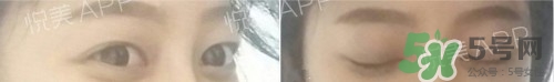 埋線雙眼皮多久恢復(fù)自然？埋線雙眼皮多久能恢復(fù)