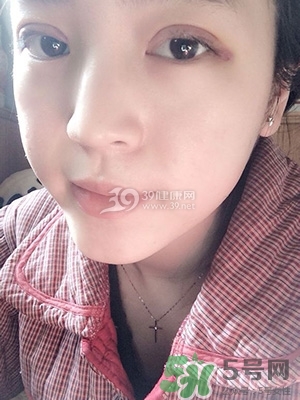 什么是定點雙眼皮？定點雙眼皮多少錢？
