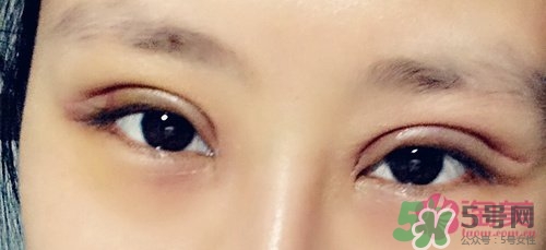 切開雙眼皮多久消腫？切開雙眼皮多久恢復(fù)？