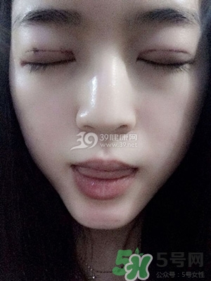 什么是定點雙眼皮？定點雙眼皮多少錢？