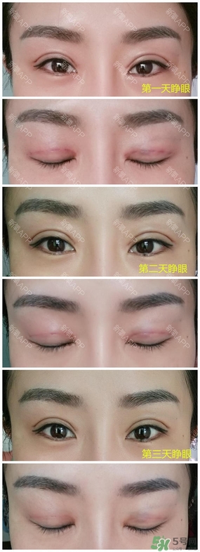埋線雙眼皮能保持多久？埋線雙眼皮是永久嗎