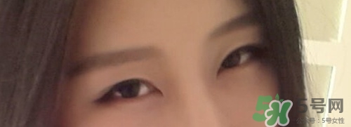 切開雙眼皮多久消腫？切開雙眼皮多久恢復(fù)？