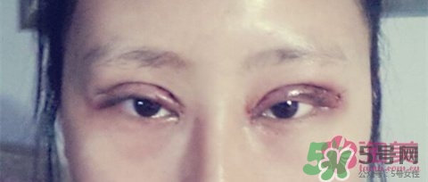 切開雙眼皮多久消腫？切開雙眼皮多久恢復(fù)？