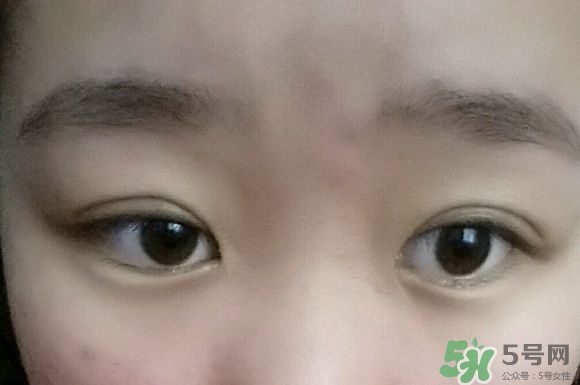 埋線雙眼皮需要拆線嗎？埋線雙眼皮怎么拆線