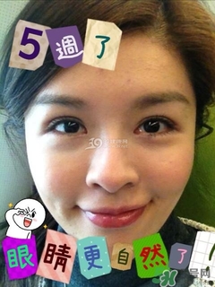 重瞼術(shù)是什么？重瞼術(shù)是永久的嗎？
