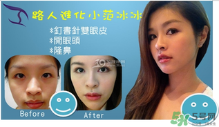 重瞼術(shù)是什么？重瞼術(shù)是永久的嗎？