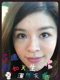 重瞼術(shù)是什么？重瞼術(shù)是永久的嗎？