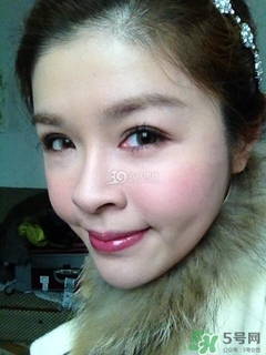 重瞼術(shù)是什么？重瞼術(shù)是永久的嗎？