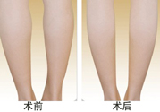 小腿吸脂多久見效？小腿吸脂后多久能看見效果？