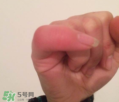 小拇指凍腫了怎么辦？為什么小拇指容易凍？