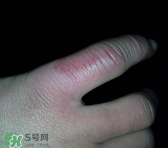 小拇指凍腫了怎么辦？為什么小拇指容易凍？