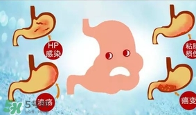 神經(jīng)性胃痙攣是什么？神經(jīng)性胃痙攣是什么原因？