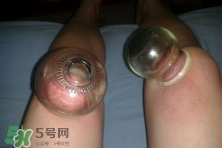 小腿能拔罐嗎？在小腿上拔火罐有什么作用？