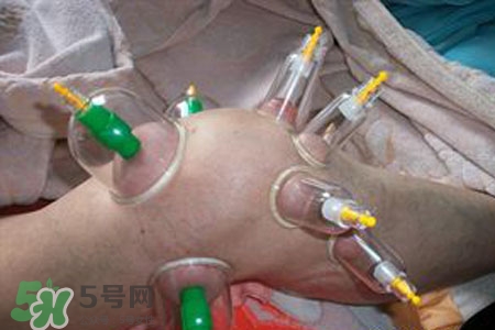 小腿能拔罐嗎？在小腿上拔火罐有什么作用？