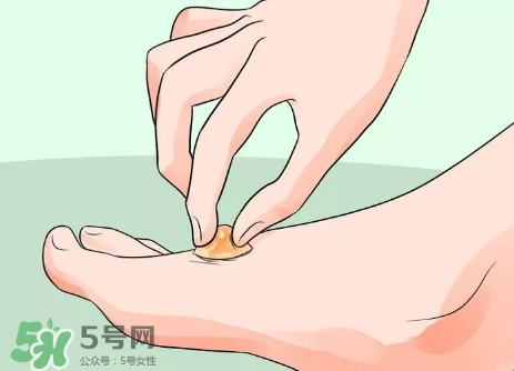 水泡怎么處理？水泡要不要刺破？